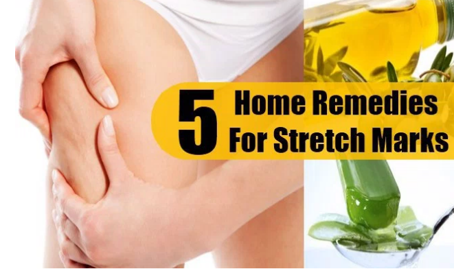 Stretch Marks Home Remedies