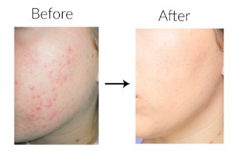 Get Rid Of Acne and dark marks
