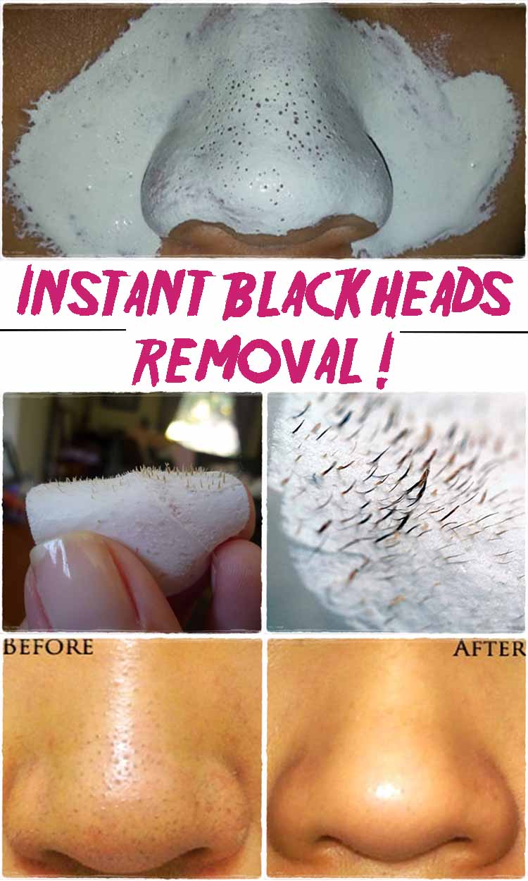 Instant blackheads removal